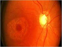 H35 381 383 Toxic Maculopathy Of Retina Decision Maker Plus