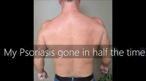Uvb Narrowband Lamp Home Phototherapy Treatment For Psoriasis And Vitiligo Uk Youtube