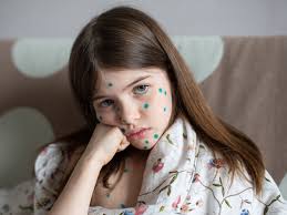 Image result for chickenpox