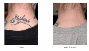 Tattoos, like body hair, are also removed by lasers, so having laser hair removal over a tattoo naturally seems like a bad combination.it is important to note that these treatments utilize two different lasers. Laser Tattoo Removal Laser Vein Removal Fraxel Laser Hair Removal Felicity M Warren Md Dermatologist