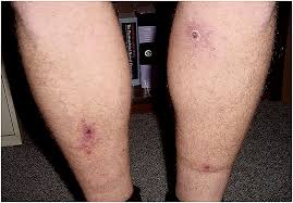 Sustantivo de género exclusivamente femenino, que lleva los artículos la o una en singular, y las o unas en plural. Cdc Larger Image Of Eschars Other Spotted Fever