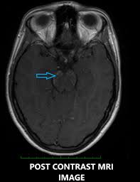 Becker p.m., jamieson a.o., brown w.d. Chronic Lymphocytic Inflammation With Pontine Perivascular Enhancement Responsive To Steroids Clippers A Rare Treatable Neuroradiological Spectrum Abstract Europe Pmc