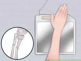 This is a moderate injury and may require splinting or casting to stabilize the joint. How To Tell The Difference Between A Wrist Sprain And A Wrist Fracture