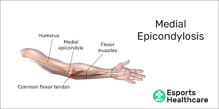 This leads to pain and tenderness on the outside of the elbow. Medial Epicondylosis Your Console Triggers May Cause Elbow Pain Esports Healthcare