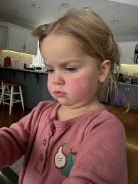 What is the hard scalely build up