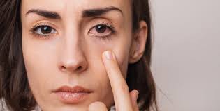 Image result for Dry Eye