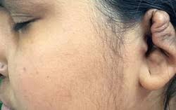 Biến chứng đáng sợ của tai "súp lơ"