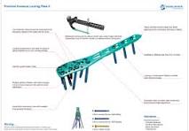 Proximal Humeral Locking Plate Ⅱ,Medical Device ...