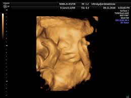 ✓ learn faster with spaced repetition. Mnilaa 1 Februar Og Gravidoppdatering Uke 40