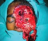 degloving injury - Google Search