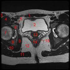 Mri Of The Female Pelvis W Radiology
