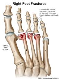 Image result for Metatarsal