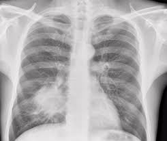 Image result for lung cancer xray