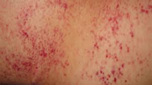 These have appeared in normal skin and in skin that has developed a sudden, patch of enlarged capillaries. Little Red Dots On Skin Naturalskins