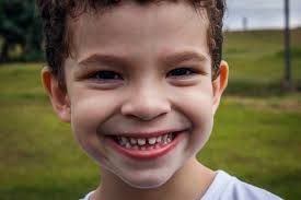 5 Facts You Need To Know About Peg Teeth Mga Dental