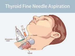 Image result for Nodule