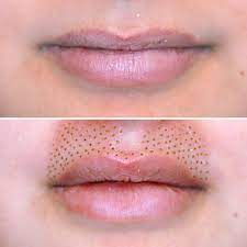 I'm down if you are. What Is Plasma Fibroblast Skin Tightening Popsugar Beauty