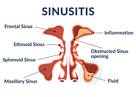 Sphenoid sinus location cysts in the sphenoid sinus Sinusitus Sinus Infection Premier Allergy Asthma Sinus Care