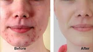 Face Bio Oil For Scars Before And After Pin On Stretch Marks And Scars