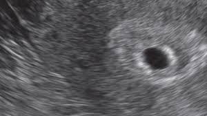 Schwangerschaft erkennen bin ich schwanger gesundheit sz de. 12 Ssw Schwangerschaftswoche Onmeda De