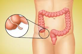 How To Find The Appendix On Imaging - Stepwards