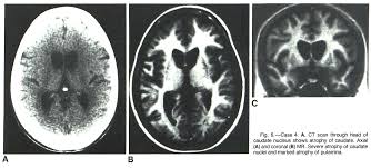Pdf Magnetic Resonance Imaging In Huntington Disease Semantic Scholar