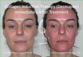 It is used in the treatment of fine lines, wrinkles or stretch marks. Dermapen Dermaroller Before After Photos Comparison In London Uk