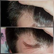 I wear wigs b/c i want to concentrate on the hair growth process only and need the protection of. Miconazole Nitrate Log And Results Hairlosstalk Forums