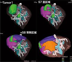 Thunderbeat を用いた肝切除 Olympus Professional Education On Demand Library