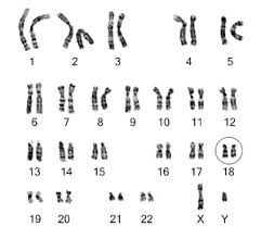 What Is A Karyotype Chromosome18