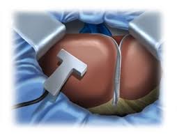 Maybe you would like to learn more about one of these? Left Lateral Liver Resection Open