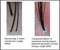 Pili multigemini is when a hair follicle is malformed and several hairs are growing out of the same hair follicle. How Many Hairs Come Out Of Each Pore Donovan Hair Clinic