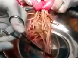 Obat cacing vermox merupakan obat cacingan yang ampuh digunakan mengatasi berbagai penyakit cacingan baik pada anak atau orang dewasa. Potret Cacing Parasit Yang Sering Dikira Mi Dan Menyumbat Usus