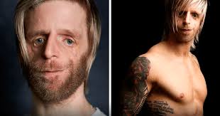 La historia de Jono: fue abandonado al nacer por una enfermedad  hereditaria, y ahora triunfa como modelo