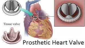 Prosthetic Heart Valve Market Size Trends Shares Insights Forecast Coherent Market Insights Aortic Valve Replacement Heart Valves Artificial Heart Valve