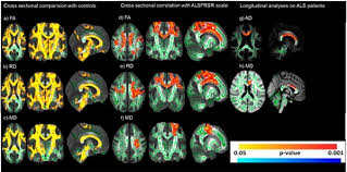 No hay ninguna prueba que pueda dar un diagnóstico definitivo de ela, aunque la presencia de señales de deterioro de las neuronas motoras superiores e inferiores en una sola extremidad constituye un fuerte. En Busca De Un Diagnostico Precoz Para La Ela Agencia Fapesp
