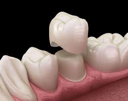 Some good quality dental crowns will last up to thirty years. How Long Will Crowns Last Family Dentist Tree