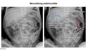 Image result for Necrotizing Enterocolitis