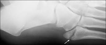 Diagnosis And Management Of Metatarsal Fractures American Family Physician