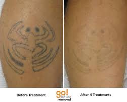 Tattoos That Aren T Done Well Or Heavily Saturated With Pigments Tend To Fade Really Quickly This Is A Prett Laser Tattoo Tattoo Removal Cream Tattoo Removal