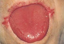 Exact data about epidemiology of the syndrome are not. Vinson Syndrome