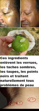 Ces Ingredients Enlevent Les Verrues Les Taches Sombres Les Taupes Les Points Noirs Et Traitent Naturellement Tous Probl Natural Medicine Health Health Tips
