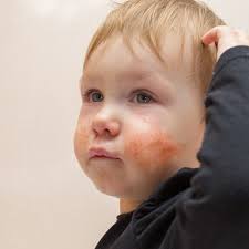 Image result for yellow scabs on the face in children