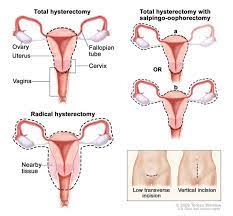 • in us about 12,000 cases resulting in 4,000 deaths per year. How We Treat Cervical Cancer Dana Farber Cancer Institute Boston Ma