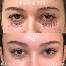 He also underwent droopy upper eyelid ptosis surgery on both eyes. Cat Eye Surgery Pony Tail Lift Plastic Surgery Cirugia Cosmetica Bleph Eye Lift Surgery Cat Eye Makeup Eye Surgery