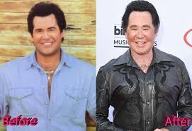 Look at these pictures before and after applying plastic surgery! Wayne Newton Plastic Surgery A Las Vegas Facelift