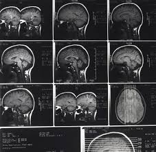 I have had at least three documented concussions. Facts About Traumatic Brain Injury Brainline