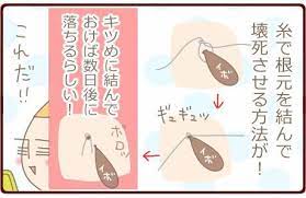 首イボの簡単な取り方 糸を使っての除去法とその他イボの種類 首 イボ イボ イボ 除去