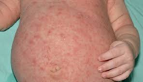 Image result for scabies in the groin area