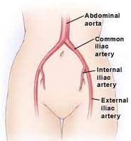 Surgery India Aortoiliac Occlusive Disease Cost Aortoiliac Occlusive